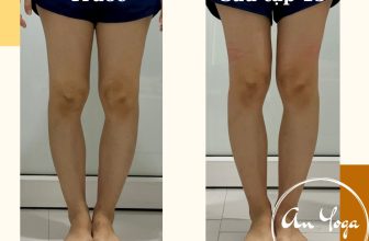 [🆕🇻🇳] An Yoga – Phòng tập dạng home studio, quy mô nhỏ 🧘 Top1Yoga 🧘 Hơn 30 năm sống cùng đôi chân vòng kiềng và dáng đi hai hàng cùng những vấn đề khác về cột sống lưng
Cô bạn này đã thử khá nhiều phương pháp chỉ mong có t , shares-0✔️ , likes-2❤️️ , date-2023-09-04 08:31:39🇻🇳🇻🇳🇻🇳📰🆕