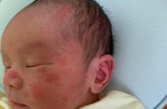 [🆕🇻🇳] Vũ Nga / Chuyên sỉ lẻ đồ sơ sinh – Quần áo trẻ em 🧑‍🧒❤️️👶⭐️ Tình trạng này gặp e Nga cái khỏi tịt luôn cả nhà ơi
Hăm,ngứa,Ronna,mẩn đỏ,muỗi đốt nhà e cập bến  SLL bôi là khỏi luôn ạ k khỏi e hoàn tiền nha
, shares-0✔️ , likes-10❤️️ , date-2024-06-15 14:37:10🇻🇳🇻🇳🇻🇳📰🆕