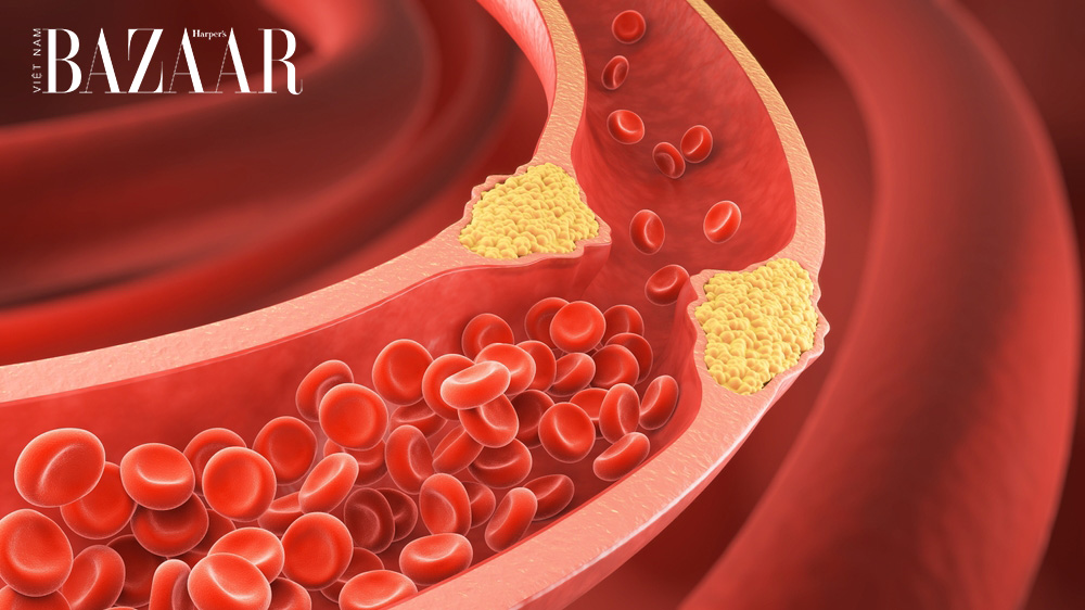 Mỡ máu cao kiêng ăn gì để tránh bị đột quỵ? [🆕🇻🇳] bazaarvietnam.vn