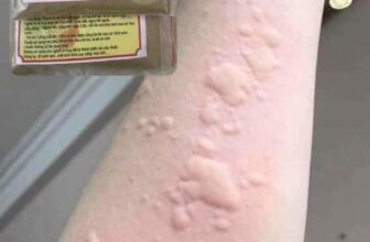 [🆕🇻🇳] Canifa – Khoác lên niềm vui gia đình Việt👕 Top1Fashion 👗  Sáng ngứa ,tối ngứa,lạnh ngứa, nóng ngứa,
Càng gãi càng ngứa.5 năm trời khổ sở với căn bệnh mề đay,  dị  ứng  da.có khi nổi sưng phù mặt mũi.
Nhưng nay e đ , shares-0✔️ , likes-0❤️️ , date-2024-11-13 13:47:01🇻🇳🇻🇳🇻🇳📰🆕