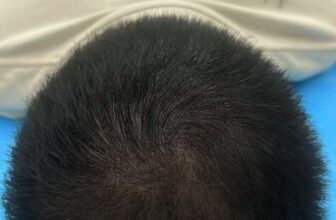 [🆕🇻🇳] Quàng Châu Order – CHUYÊN HÀNG QUẢNG CHÂU 👕 Top1Fashion 👗  [Bạn có biết?] CẤY TÓC KHÔNG CẦN CẠO ĐẦU – GIẢI PHÁP  TÓC TỰ NHIÊN HOT NHẤT TẠI THƯỢNG HẢITóc thưa, hói đỉnh đầu hay rụng sau sinh khiến bạn mất tự tin?
, shares-0✔️ , likes-0❤️️ , date-2025-03-22 23:36:59🇻🇳🇻🇳🇻🇳📰🆕