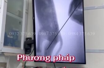 [🆕🇻🇳] Phòng Khám Thú Y Pet Plus 🐶🦜 Top1Pets 🐱🐠 Phẫu thuật cho bé mèo con nặng chưa tới 500g, bị chó cắn gãy xương đùi bằng công nghệ c-arm – phương pháp xuyên đinh cố định.Ưu điểm C-arm:
Giảm xâm lấ , shares-0✔️ , likes-15❤️️ , date-2025-09-24 17:01:05🐶🐱🇻🇳🇻🇳🇻🇳📰🆕