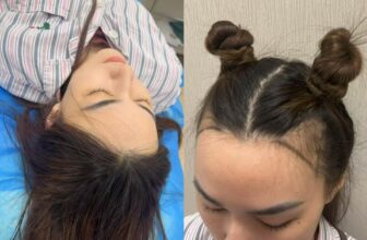 [🆕🇻🇳] Quàng Châu Order – CHUYÊN HÀNG QUẢNG CHÂU 👕 Top1Fashion 👗  CẤY TÓC NANG DÀI Ở THƯỢNG HẢI – HỒI SINH MÁI TÓC CHỈ VỚI DƯỚI 85 TRIỆU ĐỒNGBạn đang lo lắng vì tóc thưa, hói, đường ngôi ngày càng lộ rõ?
Giải pháp hiện  , shares-0✔️ , likes-0❤️️ , date-2025-05-19 21:30:31🇻🇳🇻🇳🇻🇳📰🆕