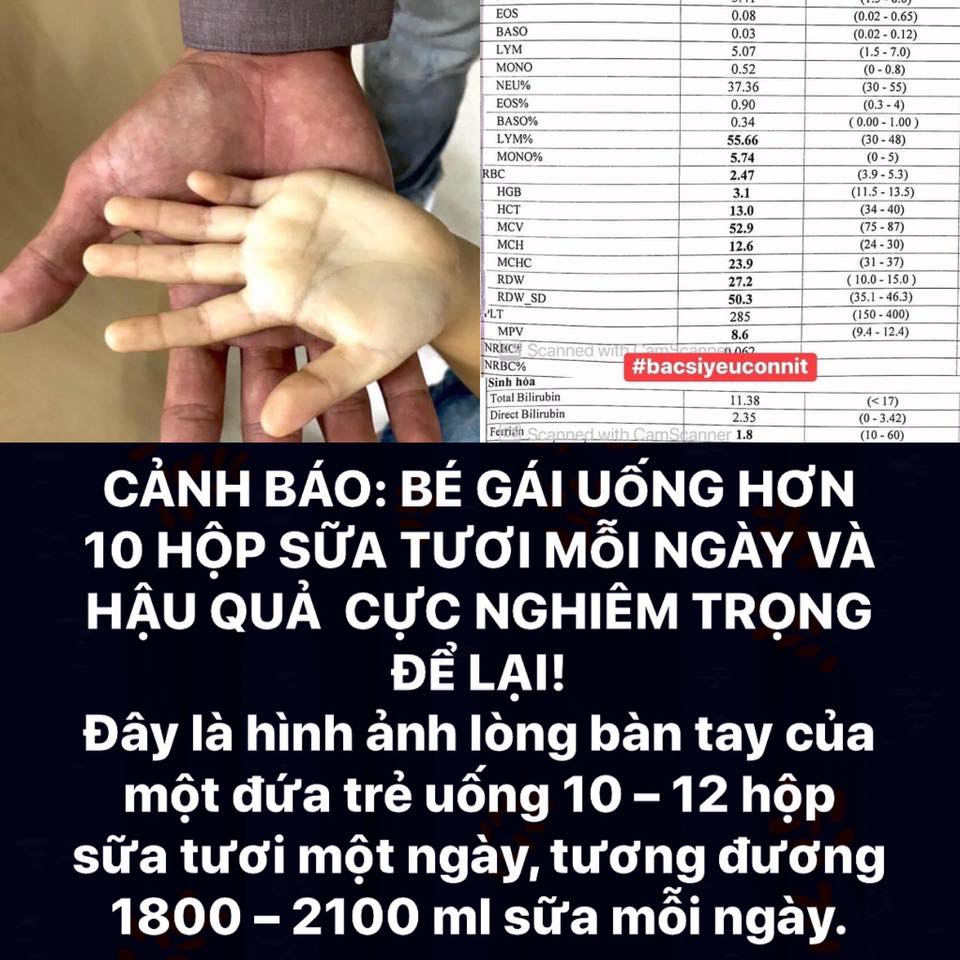 [🆕🇻🇳] Lubaby – Thời trang trẻ em 🧑‍🧒❤️️👶⭐️ LỜI CẢNH TỈNH: Đây là hình ảnh lòng bàn tay của một đứa trẻ uống 10 – 12 hộp sữa tươi một ngày, tương đương 1800 – 2100 ml sữa mỗi ngày.

Lý do?

Mẹ rất bậ , shares-5✔️ , likes-1❤️️ , date-2020-06-10 04:52:13🇻🇳🇻🇳🇻🇳📰🆕